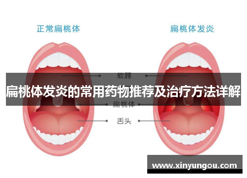 扁桃体发炎的常用药物推荐及治疗方法详解
